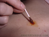 iodo-melanoma