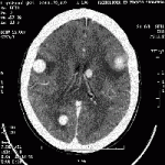 cerebral melanoma 1