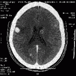 cerebral melanoma 3