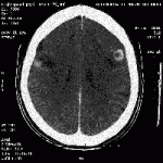 cerebral melanoma 4