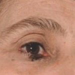 eye melanoma 1
