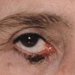 eye melanoma 2