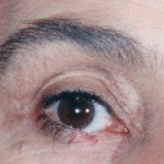 eye melanoma 4