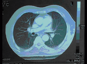 hepatic carcinoma pulmonary metastasis 2