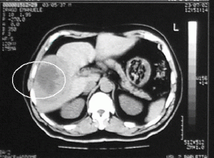 hepatic carcinoma pulmonary metastasis 3