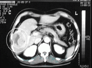hepatic carcinoma pulmonary metastasis 4