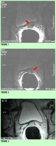 prostate carcinoma