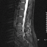 medullar metastatic compression 1