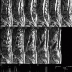 medullar metastatic compression 2