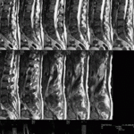 medullar metastatic compression 4