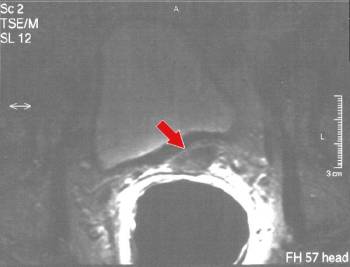prostate cancer