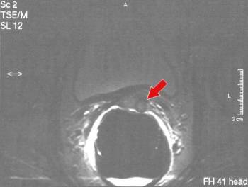 prostate cancer