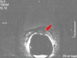 prostaten carcinoma