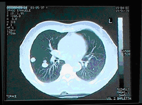 hepatic carcinoma with pulmonary metastasis