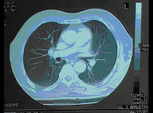 hepatic carcinoma with pulmonary metastasis