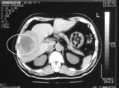 hepatic carcinoma with pulmonary metastasis