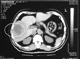 hepatic cancer catscan-3