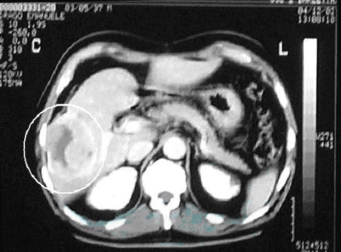 hepatic carcinoma with pulmonary metastasis