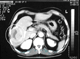 hepatic cancer catscan-4