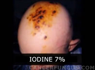 skin cancer iodine treatment
