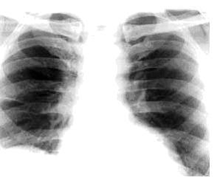 lungs after sodium bicarbonate treatment