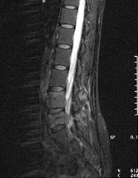 Medullar metastatic compression 1