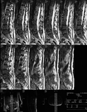 Medullar metastatic compression 2