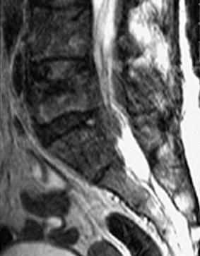 Medullar metastatic compression 1