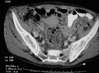 hepatic cancer pdf3