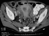 hepatic cancer pdf4